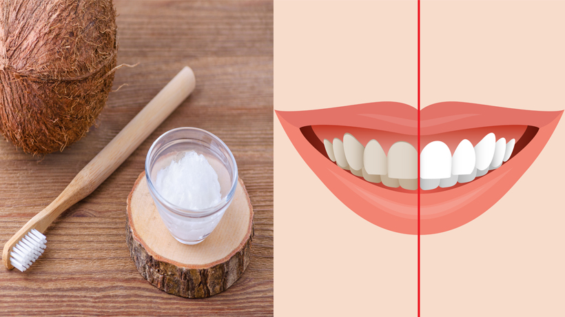5 Remedies To Whiten Teeth Naturally Womenworking