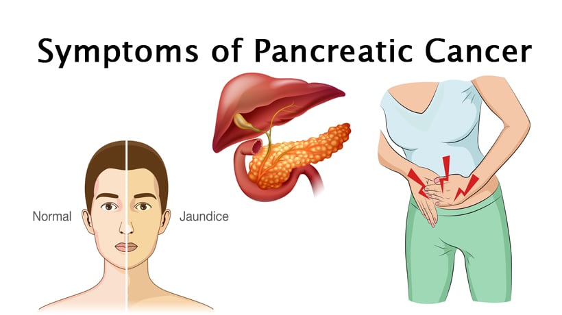 Pancreatic cancer abdominal bloating. Priznaky hpv viru u muzu