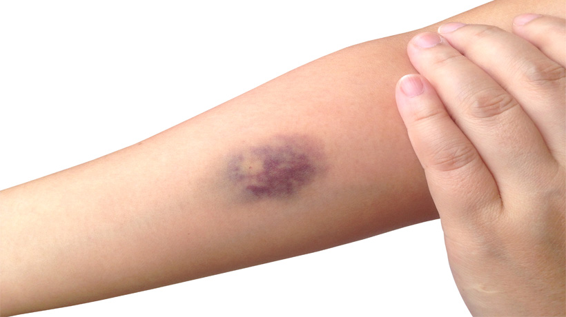 7 Not So Obvious Reasons For Bruising Easily Womenworking