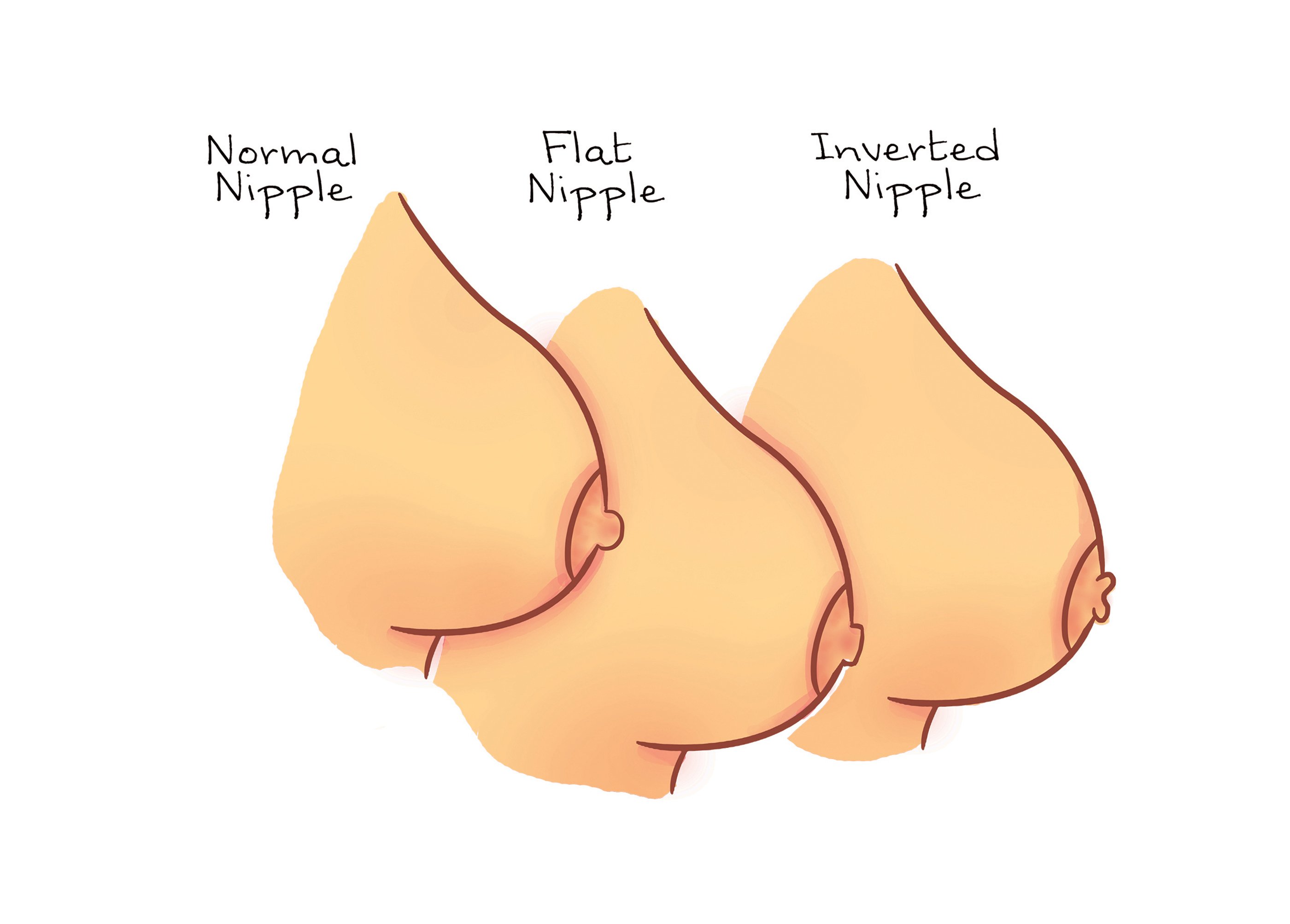Changes in nipple shape, illustration - Stock Image - F034/4697